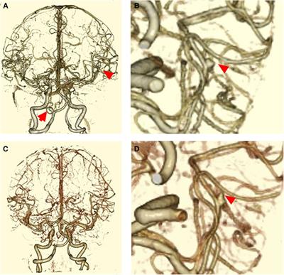 Case report: Unruptured small middle cerebral artery aneurysm with perianeurysmal edema